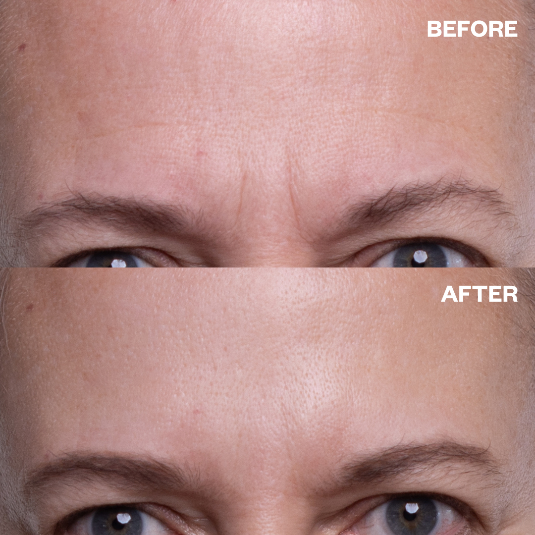 Reusable Forehead Wrinkle Patches