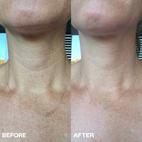 Reusable Neck Wrinkle Patch
