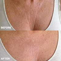 Reusable Chest Wrinkle Patch